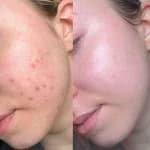 Acne & Breakouts